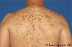 Hyperpigmentation is a broad term that refers to a very common skin issue: Get Rid Of Hyperpigmentation In 4 Steps Hyperpigmentation Treatments