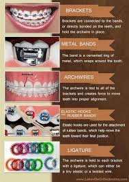 Dentaltown The 5 Basic Parts To Braces Brackets Metal Bands Archwires Elastic Hooks And Rubber Bands Lig Braces Tips Dental Braces Orthodontics Braces