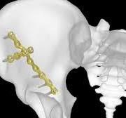 Pelvic Plating System | Acumed