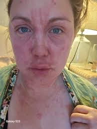 Anyone else constantly itchy?!