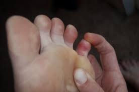 Dari alasan itulah, sarung tangan didesain agar jari kelingking menempel pada jari manis. Patah Jari Kecil Di Kaki Pertolongan Cemas