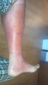 What is the differential diagnosis of cellulitis? Cellulitis Wikem