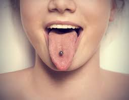 If you notice red streaks radiating out of the piercing hole and running down the sides and the front your tongue, this indicates the presence of an advanced infection going on, which requires an immediate antibiotic treatment. How To Treat Tongue Piercing Infection