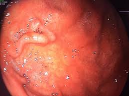 Image result for Colonoscopy in GI Bleeding