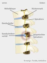 Bandscheibenvorfall Symptome Diagnose Behandlung Netdoktor