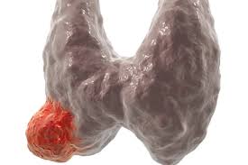 Some thyroid cancer symptoms include small, painless lumps in the front of the neck, hoarseness, and trouble swallowing. Thyroid Cancer 13 Things You Need To Know