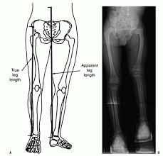 Image result for Functional Leg Length Discrepancy