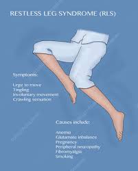 Image result for Restless Leg Syndrome