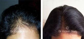 Home remedies for hair growth and thickness. Homeopathic Medicines And Treatment Highly Effective No Side Effects At Life Force Homeopathy Clinic