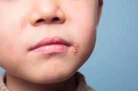 If they want to eat then. Cold Sores Fever Blisters In Kids Causes And Treatment