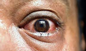 Check spelling or type a new query. Mucormycosis Black Fungus Infection In Eye Facts And Myths Virinchi Hospitals Hyderabad