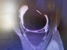 Leziune grad ii corn posterior menisc intern ruptura incompleta lia (traumatism mai vechi) leziunea de menisc are 3 saptamani si a survenit in urma unei entorse de genunchi ( + intindere ligament ) la ski. 1 Ruptura Grad Iii Corp Posterior Dr Jalba Bogdan Alexandru Facebook