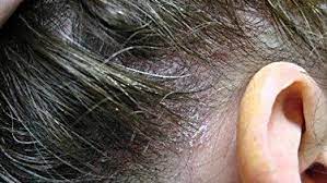 Bumps On The Scalp That Itch Main Causes Treatments That Work Scalps Dry Scalp Itch
