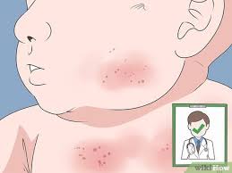 Is it baby acne, a rash, or something else? 3 Ways To Get Rid Of Baby Acne Wikihow