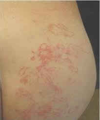 Occurs mainly in children < 2 years. Acute Serpiginous Rash Mdedge Dermatology