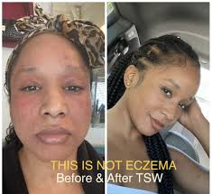 Lea Vasquez shares her Topical Steroid Withdrawal experience : u/Lea_Vasquez