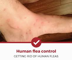 human flea control getting rid of