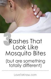 Ant Bites That Look Like Mosquito Bites Rash That Looks Like Mosquito Bites Lovetoknow Skin Rashes Pictures Types Of Skin Rashes Skin Infection Remedy