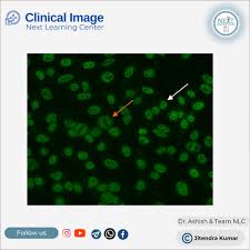 Image result for ANA Staining Pattern