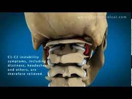 C1 And C2 Atlantoaxial Instability Youtube