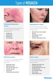 Image result for demodex rosacea