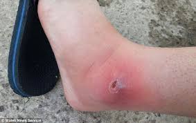 Find out how to recognize the spider, its bite, and the symptoms. Gardener Bitten By False Widow Spider Nearly Loses His Leg Daily Mail Online
