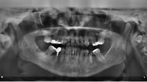 Orthodontic Imaging Solutions Handheld Dental X Ray Systems Amalgam Fillings Dental Dental Fillings