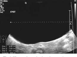 Ovulation happens when these cysts are around 2 to 3 cm in size. Figure 2 From A Giant Ovarian Cyst In A Neonate Semantic Scholar