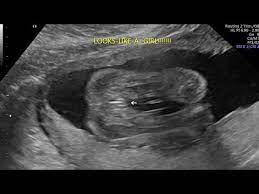 How To Get Your Baby To Open Their Legs For Sonogram Youtube
