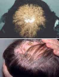 However, most sources of scalp. Michael Jackson S Hair Loss What Happened To His Bald Spot