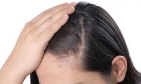 And while iron deficiency and anemia might be to blame for your hair loss, you'll need to consult with a doctor before taking iron supplements or making other significant changes to your lifestyle. Thinning Hair It Might Be Female Pattern Baldness Dr Batra S