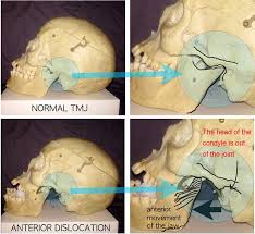 Image result for Jaw Dislocation