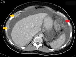 Ultrasound scan and computed tomography (ct) findings are also insufficient and nonspecific to establish a diagnosis of peritoneal mesothelioma. Malignant Mesothelioma Imaging