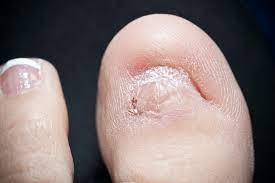 My Toenail Came Off Now What Triad Foot Ankle Center