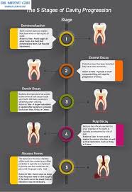 The 5 Stages Of Cavity Progression Dentistry Dental Pictures Dental Facts