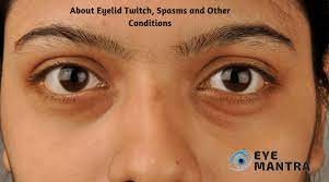 Eyelid Twitch | Causes, Treatments, And Complications | Eyemantra |