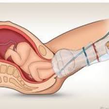 Image result for Forceps Assisted Delivery