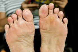 Plantar warts are skin growths that appear on the soles of the feet. Will Dandelion Root Banish Plantar Warts The People S Pharmacy