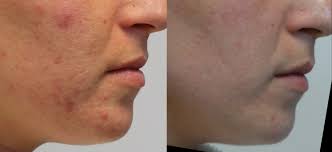 Isotretinoin versus placebo in the treatment of cystic acne. Acne Rosacea Treatments Richmond Skin Laser