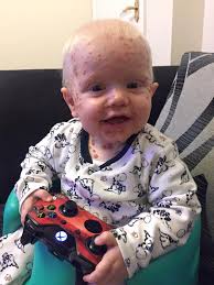 Maman pense que l'éruption cutanée de son fils est la varicelle, s'avère  être une maladie qui n'arrive qu'une fois sur 100.000