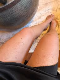 Image result for liver spots on legs