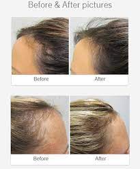 Vitamin e is very essential for hair growth because it's ideal to use if you want a healthy scalp. Viviscal Professional Hair Growth Programme