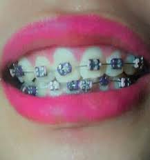 Dark Violet And Light Pink Braces Cute Braces Colors Braces Colors Braces Girls
