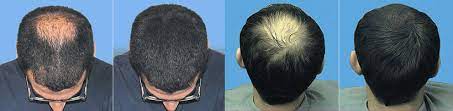 Wig To Cover Bald Spot Off 65 Www Abrafiltros Org Br