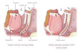 Image result for Sleep Apnea