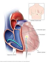 Ventricular Tachycardia Ablation Type Mayo Clinic Ventricular Tachycardia Implantable Cardioverter Defibrillator Afib