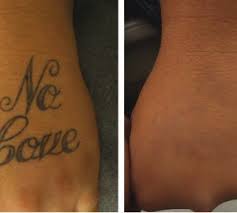 Laser tattoo removal in carbondale on yp.com. Laser Tattoo Removal In Crest Hill Naperville Premier Dermatology