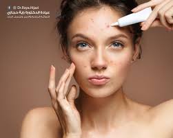 هنالك بعض الأشخاص الذين يعانون من #حب_الشباب بشكل مفاجئ وقد يكون السبب  استخدام الكريمات و الغسولات الغير مناسبة للبشرة، أو حتى إستخدام حبوب لعلاج  مشاكل صحية أخرى، لذلك عليك مراجعة طبيب الجلدية