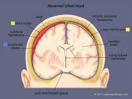 Shaken Baby Subdural Hematoma Medical Art Library