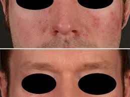 In der regel wird ein hautarzt erst mal antibiotika oder eine äußere therapie versuchen, bevor er dir roaccutan oder aknenormin verschreibt. Isotretinoin Altmeyers Enzyklopadie Fachbereich Dermatologie